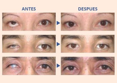 prótesis oculares